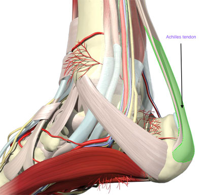 Achilles Tendonitis