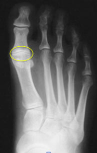 Big toe arthritis - Hallux Rigidus