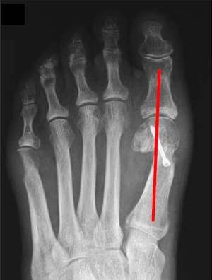 Bunion Surgery