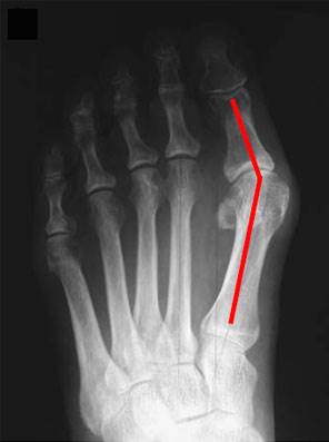 Bunion Surgery