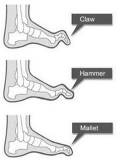 Lesser toe problems