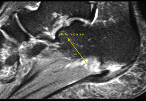 Heel pain - Plantar fascitis