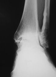 Ankle Fusion