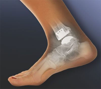 Total Ankle Replacement