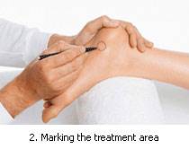 Extra Corporeal Shock Wave Therapy