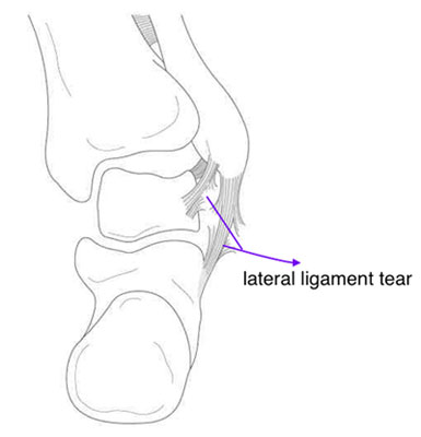 Ankle ligament reconstruction