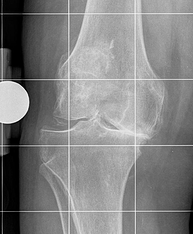 Knee Arthritis