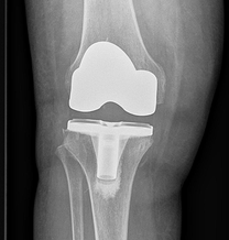 Knee Arthritis