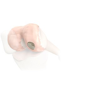 Bioploy implants