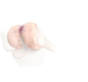 Bioploy implants
