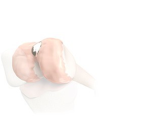 Bioploy implants
